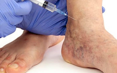 The Best Treatments for Varicose Veins