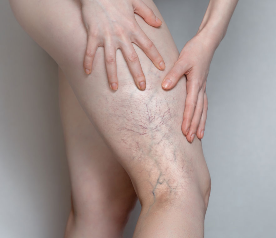 About the Procedure - Sclerotherapy in Columbus, Ohio