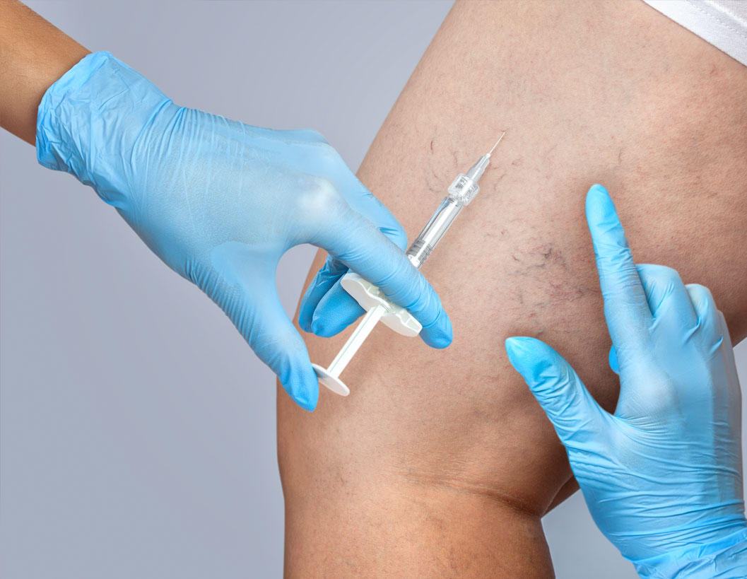 What is Sclerotherapy Treatment?