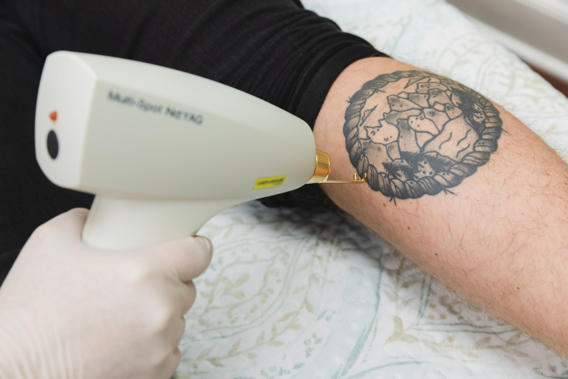 Tattoo Removal in Columbus | Polaris Vein & Aesthetics