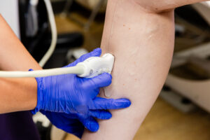 A close shot of gloved hands performing varicose vein treatment near New Albany, OH.